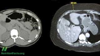 Metabolic Syndrome and PlantBased Diets [upl. by Noscire]