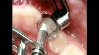 Amalgam Fillings Procedure  Lake Merritt Dental Oakland CA [upl. by Vlad628]