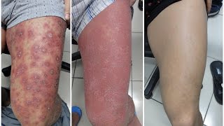 Dealing with Itching of Psoriasis [upl. by Edd905]