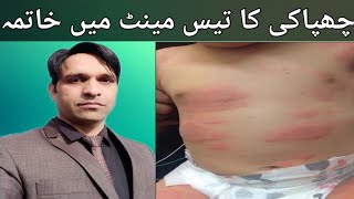 Urticaria homeopathic treatment  Urdu Hindi  چھپاکی کا ہومیو پیتھک علاجbesttreatment urticaria [upl. by Dopp]