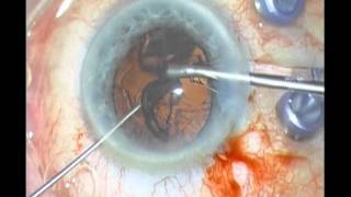 Bonus video Lens injury after intravitreal injection [upl. by Neddy]