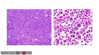 germ cell tumor comparisonsGYNpath [upl. by Enrobyalc371]