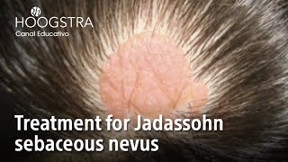 Treatment for Jadassohn sebaceous nevus  22199 [upl. by Aleek]