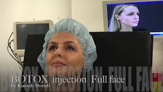 Botox behandling göteborg  Full face botox injection by Kiarash Moradi [upl. by Sebbie]