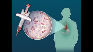 Dupilumab for Eosinophilic Esophagitis  NEJM [upl. by Glogau]