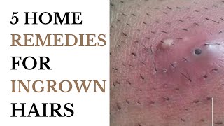 5 Home Remedies For Ingrown Hairs [upl. by Viglione]