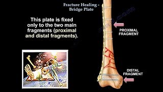 Fracture Healing Bridge Plate  Everything You Need To Know  Dr Nabil Ebraheim [upl. by Bork]