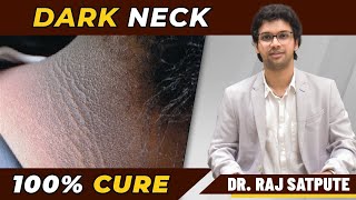 Neck Acanthosis Nigricans  Dark Neck 100 Cure  Dr Raj Satpute [upl. by Leicester]