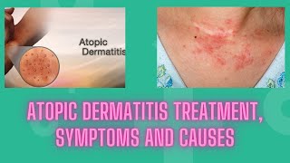 Atopic dermatitis treatment symptoms and causes  Nuse Healthy [upl. by Anatak]