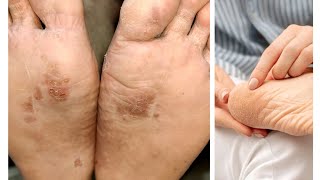 homemade Foot care tips Dry cracked Heel Care routine for instant Soft smooth Feet [upl. by Eibur]