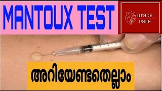 Mantoux Test  Tuberculin Skin Test TST Malayalam [upl. by Anileda]