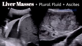 Liver masses  Cancer   Pleural FLuid  Ascites  Ultrasound [upl. by Comras]