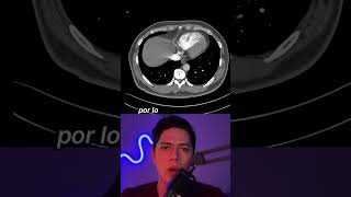 Diagnóstico Radiológico de Tromboembolia Pulmonar Un Caso Clínico [upl. by Zavras749]