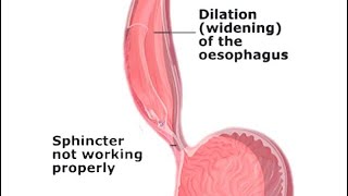 Mcqs on Achalasia cardianeetpg medicalstudent neetpgpreperation mbbssurgeryeducation [upl. by Curr115]