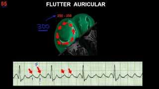 CURSO DE ELECTROCARDIOGRAFIA 55  FLUTTER Y FIBRILACIÓN AURICULARES [upl. by Oriana522]