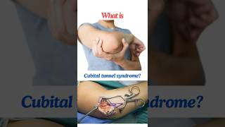 Cubital tunnel syndrome Ulnar neuropathy at the elbow shorts osborneband [upl. by Shantha]