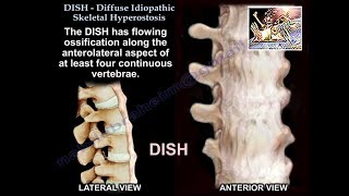 DISH Diffuse Idiopathic Skeletal Hyperostosis  Everything You Need To Know  Dr Nabil Ebraheim [upl. by Niret]