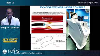 Laser Atherectomy in Calcium Management HD 720p [upl. by Yaja474]