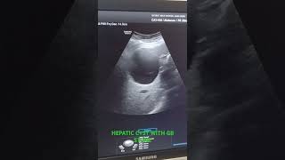 HEPATIC CYST WITH GB STONE usg radiodiagnosis GB [upl. by Kella749]