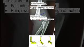 Supracondylar fracture [upl. by Aggri767]