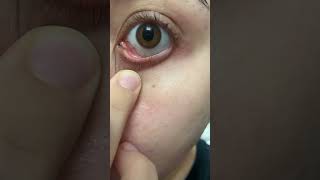 Mucus fishing in my eye ball after removing eye makeup [upl. by Llerat]