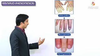 Raynauds phenomenon  Raynauds disease amp Raynauds syndrome [upl. by Sidras]