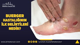 Buerger Hastalığının İlk Belirtileri Nedir  Prof Dr Mustafa Hakan Zor [upl. by Tarah]