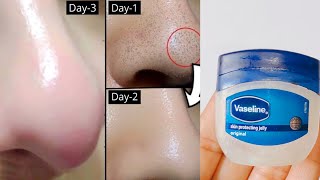 How to remove blackheads and Whiteheads from nose and face naturally at home [upl. by Assilym586]