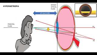 Retinoscopy part 1 Dr Zain Khatib [upl. by Sacksen]