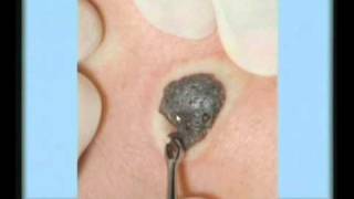 Seborrheic Keratosis Treatment [upl. by Yuzik]