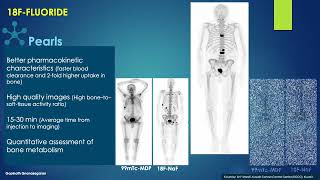 PSNM 2024  Imaging Bone Metastases SPECT amp PET  Gopinath Gnanasegaran UK [upl. by Ynnad267]