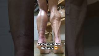 75 Day Calf Tear Recovery [upl. by Kevina311]