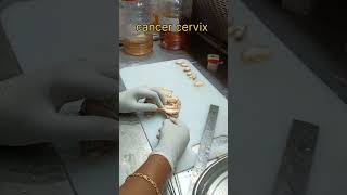 cancer cervix specimen grossing cervix  கருப்பை வாய் புற்றுநோய்  pathology cervicalcancer [upl. by Melar]