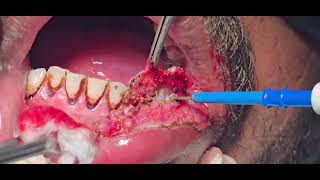 Verrucous carcinoma lip excision cautery laser  Dr Hitesh Patel [upl. by Brackely]