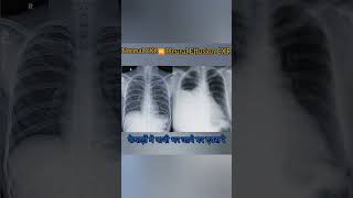 Diffrence between Normal Chest X ray ampPleural effusion medicalimaging xray radiology [upl. by Charteris]