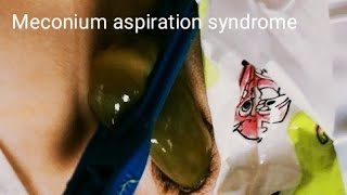 Meconium Aspiration Syndrome  Pediatrics [upl. by Woodie884]