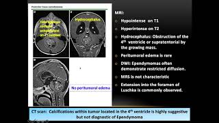 Pediatric Ependymoma Genetics Molecular Classifications and Role of RadiationDr Tanweer Shahid [upl. by Devy]