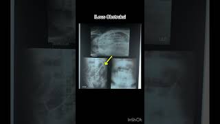 Ileus obstruksi xray radiology pemeriksaankesehatan bhojpuri [upl. by Greysun]