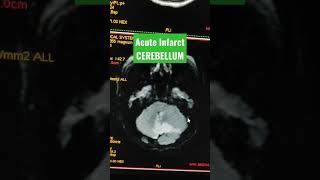 Large Acute Infarct in Cerebellum viral youtubeshorts mri [upl. by Geraud]