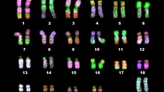 Karyotyping indications and its interpretation [upl. by Einre]