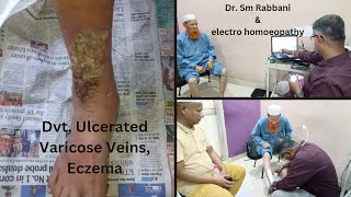 ULCERATED VARICOSE VEIN WITH ECZEMA [upl. by Otsedom]