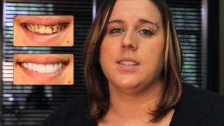 Real Press On Veneer Client Review  Client reviews removable veneers for the first time [upl. by Nyre]