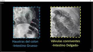 OBSTRUCCION INTESTINAL FULL [upl. by Eelirem]