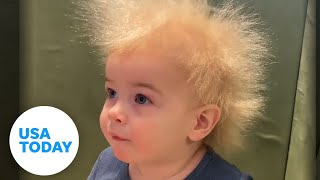 Uncombable hair syndrome Babys ultrarare follicle genes [upl. by Riha293]