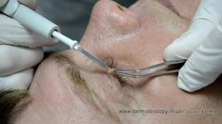 Soft fibroma  removal by highfrequency electrosurgery [upl. by Uzzial]