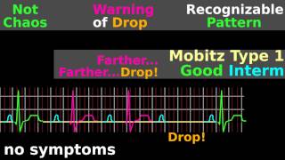 ECG Tutorial AV block EKG Mobitz electrocardiogram interpretation [upl. by Dante138]