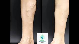 Laser Treatment and Sclerotherapy of Varicose Veins [upl. by Jangro718]