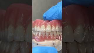 Process Hybrid Locator Denture EnvisiontecMain envisiontec dental teeth smile lsk121shorts [upl. by Zerat686]