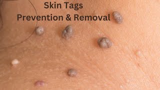 How To Remove and Prevent Skin Tags [upl. by Starbuck]