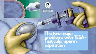 The 2 Major Problems with TESA Testicular Sperm Aspiration drmalpani malpaninifertilityclinic [upl. by Mishaan350]